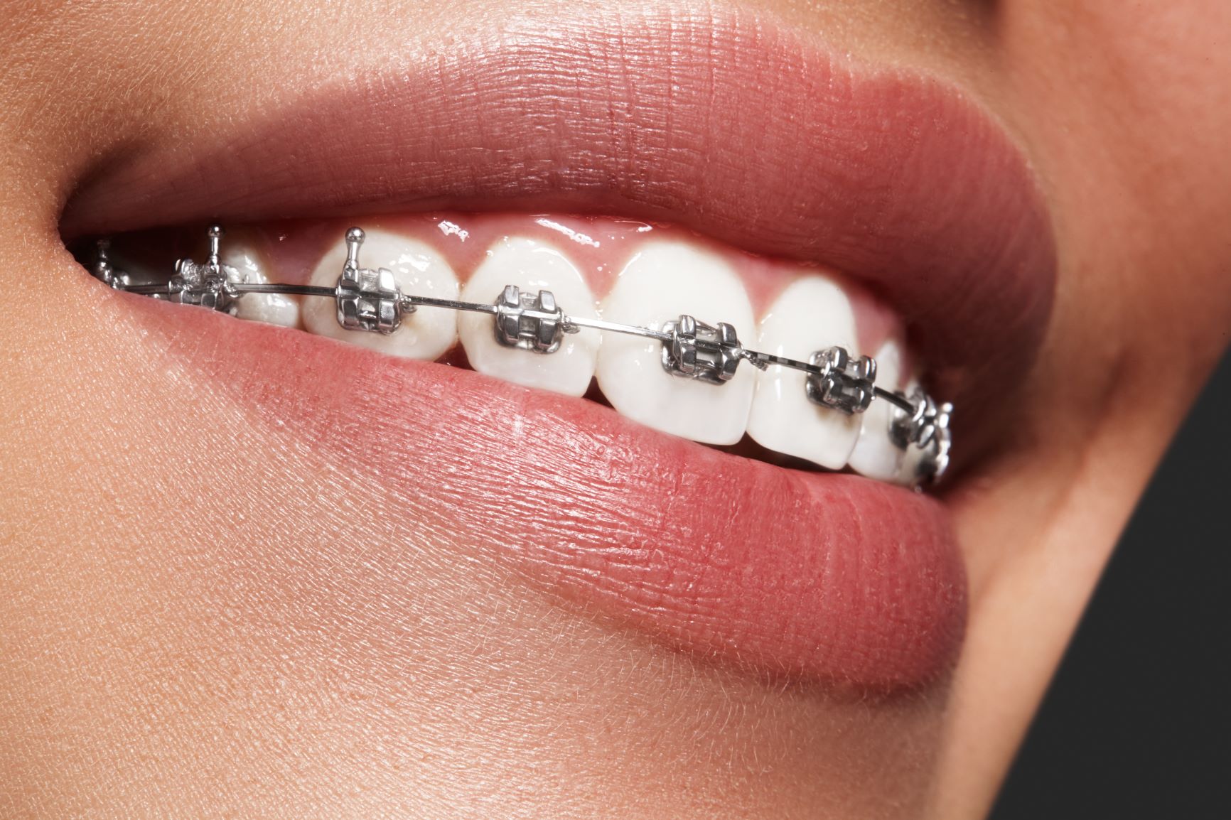 The Smile Space orthodontie - l'appareil dentaire métallique