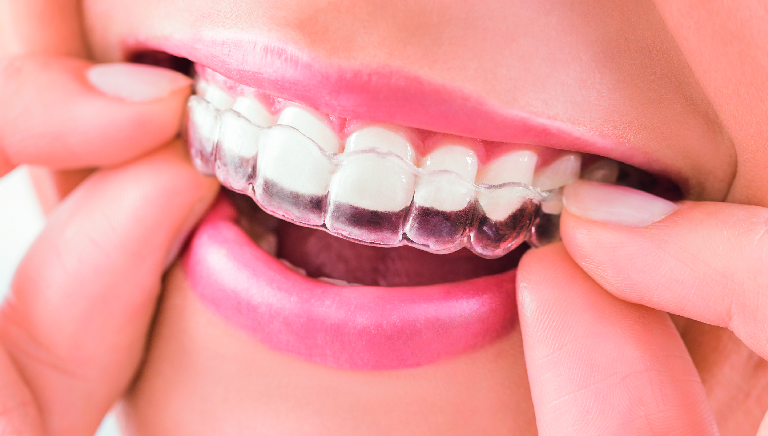 The Smile Space orthodontie -  Les gouttières invisalign