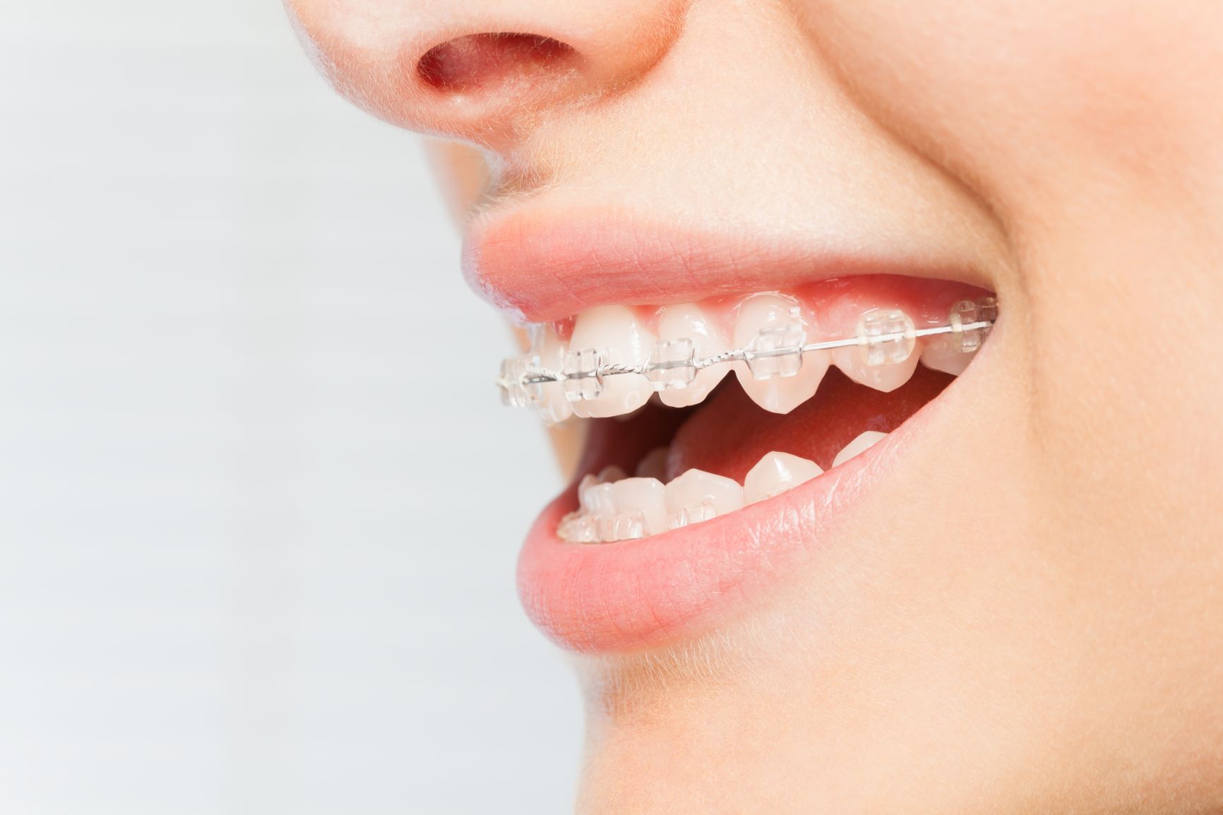 The Smile Space Orthodontie - L’appareil dentaire avec plaquettes transparentes